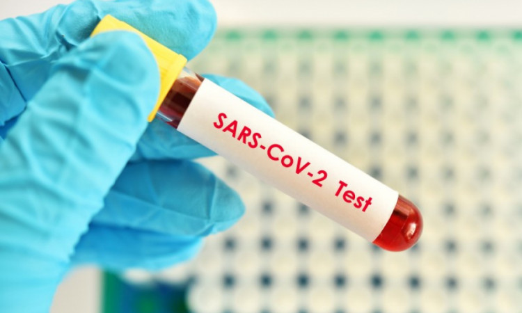 Ilościowe oznaczenie anty-SARS-CoV-2 IgG w IPCZD
