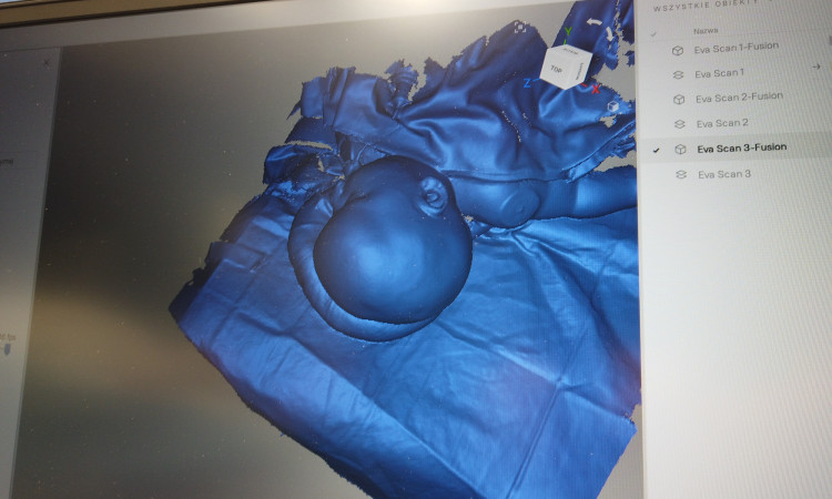 Skaner Artec 3D do oceny leczenia małoinwazyjnego kraniosynostoz.