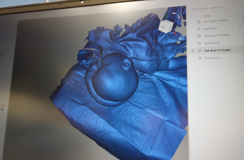 Skaner Artec 3D do oceny leczenia małoinwazyjnego kraniosynostoz.